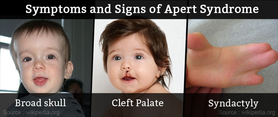 apert syndrome