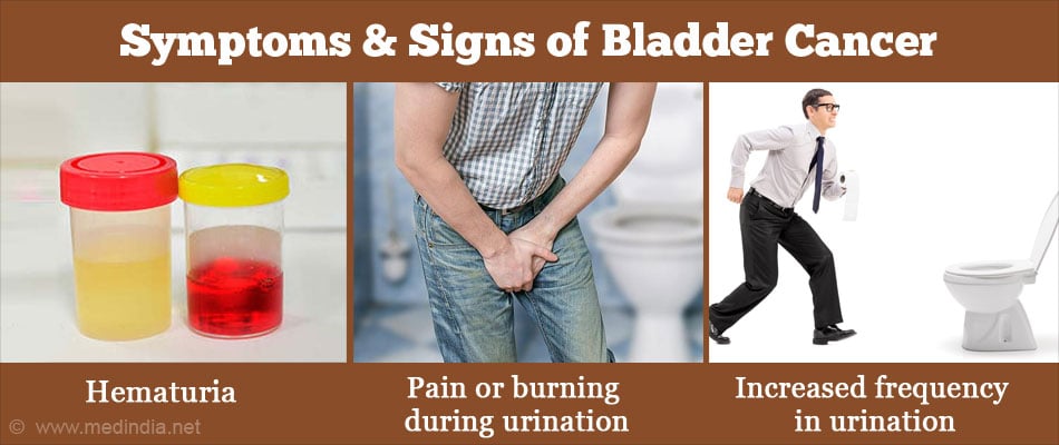 Bladder Cancer – Symptoms, Signs, Diagnosis, Treatment, Prognosis ...