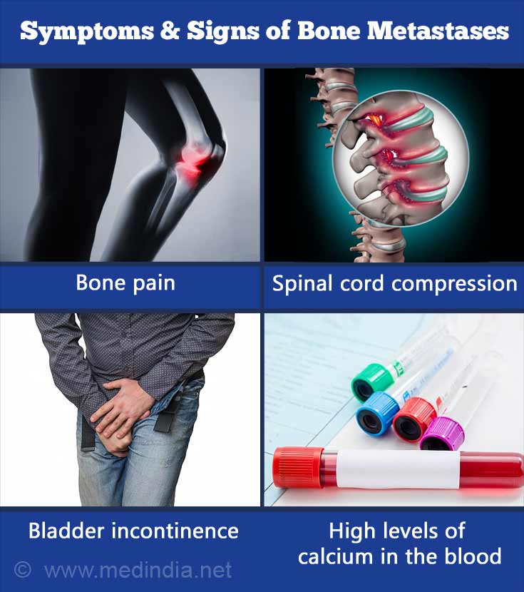 Symptoms Of Metastatic Bone Cancer Doctorvisit