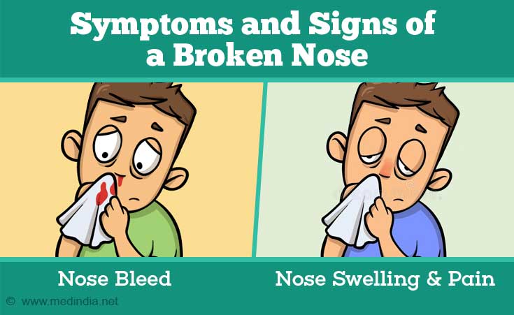 Broken Nose (Nasal Fracture) - Age groups and Types, Symptoms ...