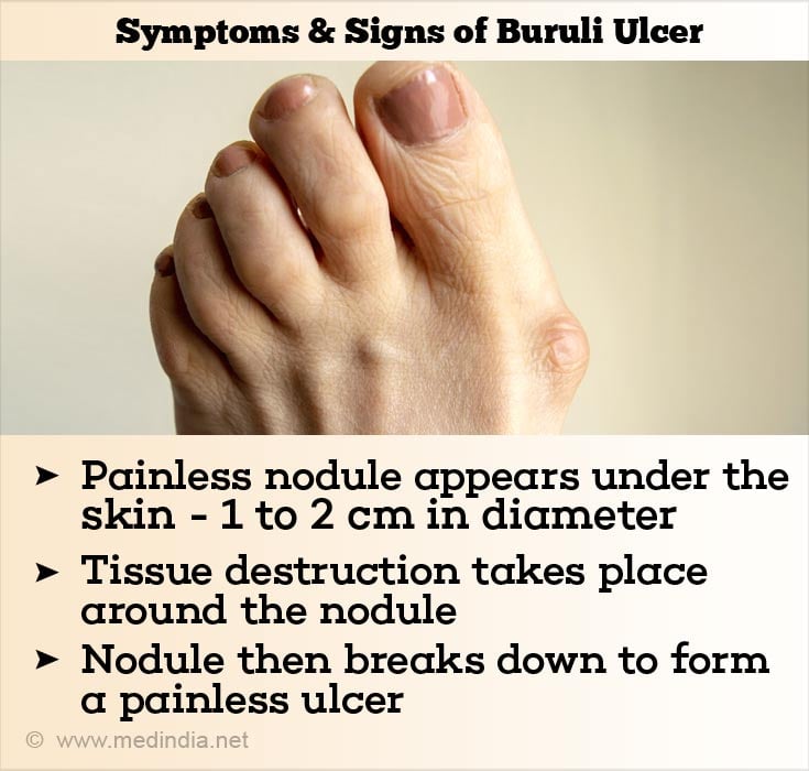 buruli-ulcer-causes-symptoms-diagnosis-treatment-prognosis