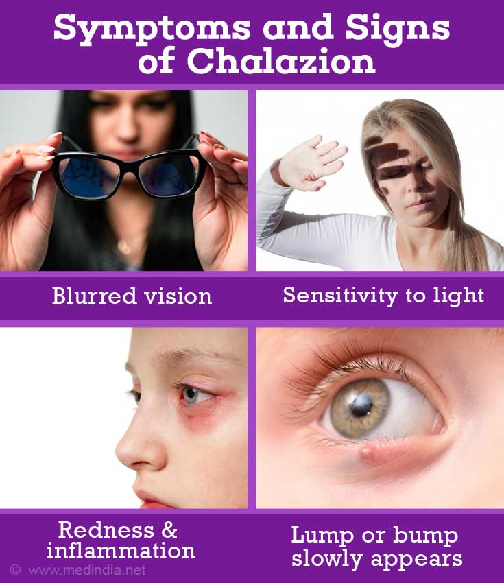 Chalazion (Eyelid Condition) - Causes, Symptoms, Signs, Diagnosis ...