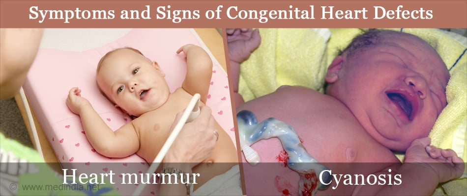 congenital heart defects symptoms