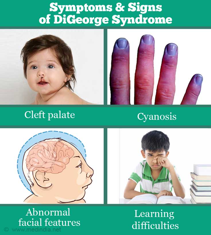 DiGeorge Syndrome - Causes, Symptoms, Diagnosis, Treatment & Prognosis