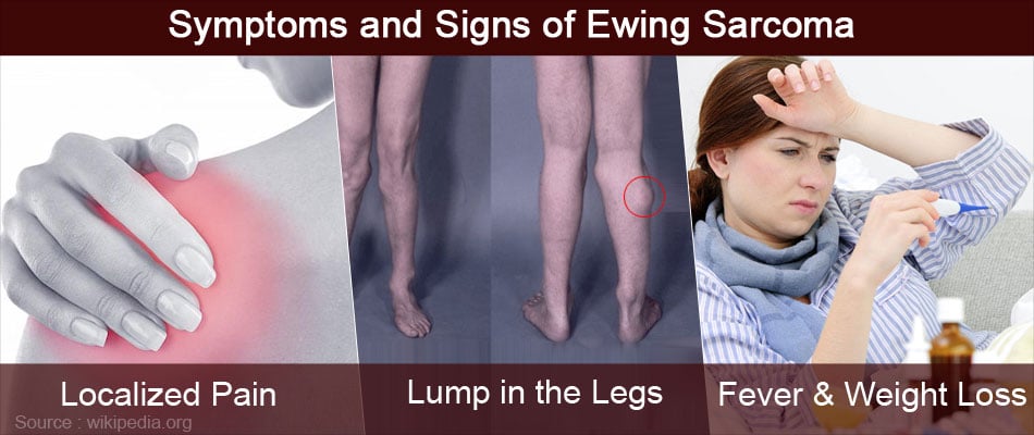 sarcoma cancer in leg symptoms