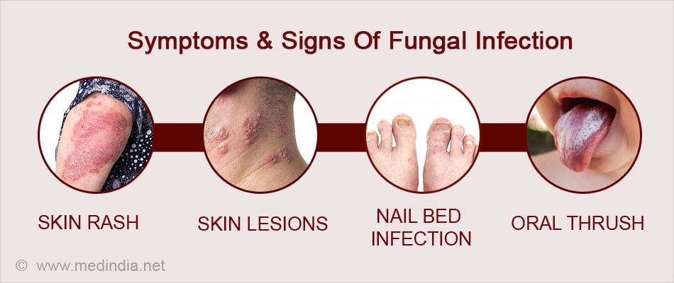 Fungal Infections Causes Symptoms Diagnosis Treatment Prevention