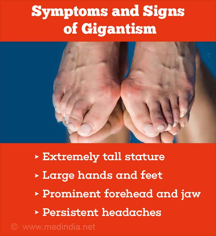 gigantism in children symptoms