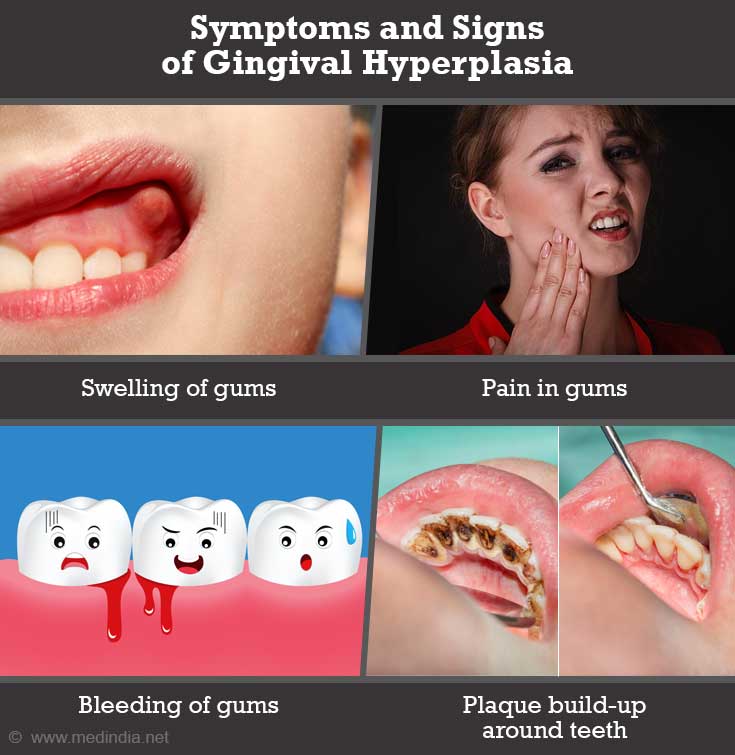 Symptoms and Signs of Gingival Hyperplasia Symptoms and Signs of Gingival Hyperplasia