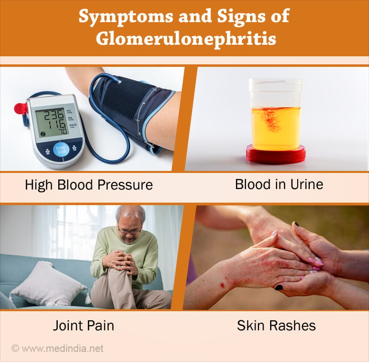 Symptoms and Signs of Glomerulonephritis