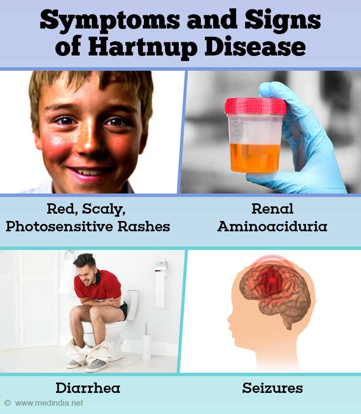 Hartnup Disease - Causes, Symptoms, Diagnosis, Treatment and Prevention