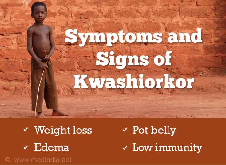 Signs And Symptoms Of Kwashiorkor