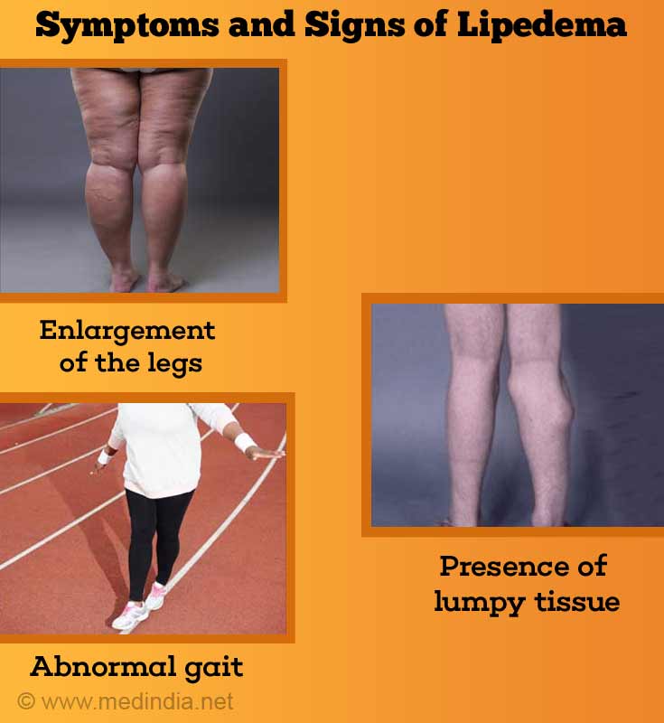 Lipedema - The Disease They Call FAT - Numerous patients with