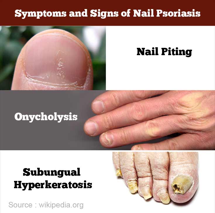 onycholysis psoriasis