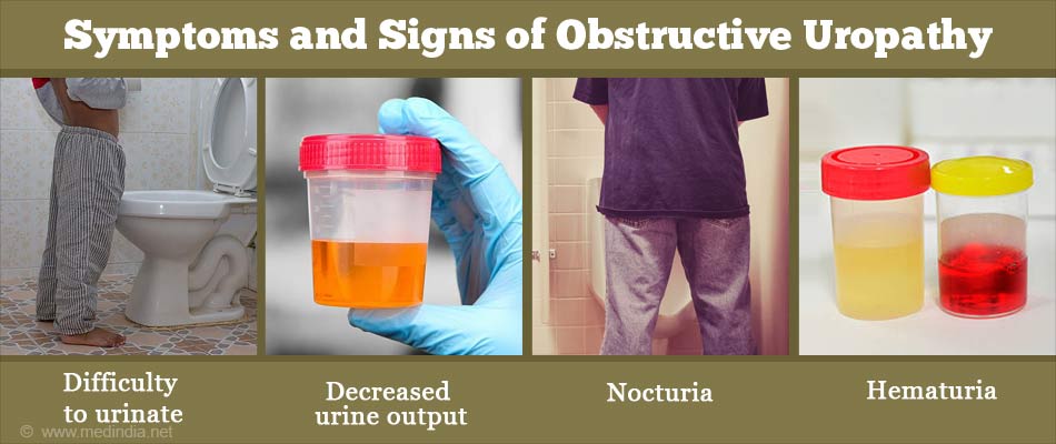 Obstructive And Reflux Uropathy Signs And Symptoms