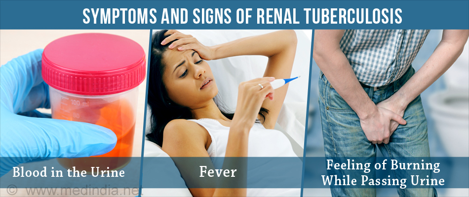 Symptoms and Signs of Renal Tuberculosis Symptoms and Signs of Renal Tuberculosis
