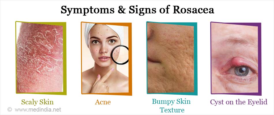 Rosacea Causes Types Symptoms Diagnosis Treatment Prevention