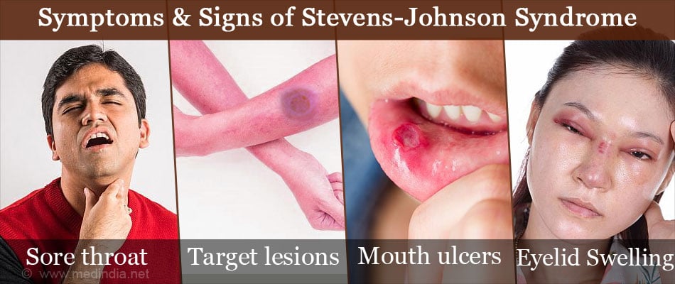 stevens-johnson-syndrome-causes-symptoms-diagnosis-treatment