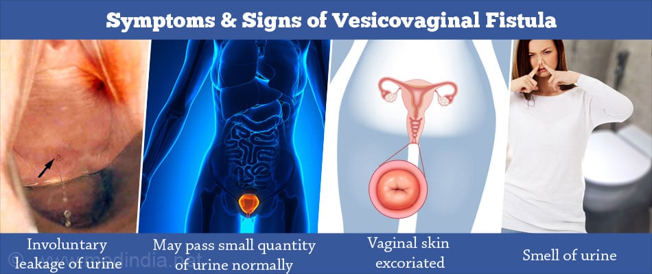 Vesicovaginal Fistula Causes Symptoms Diagnosis Treatment Prevention