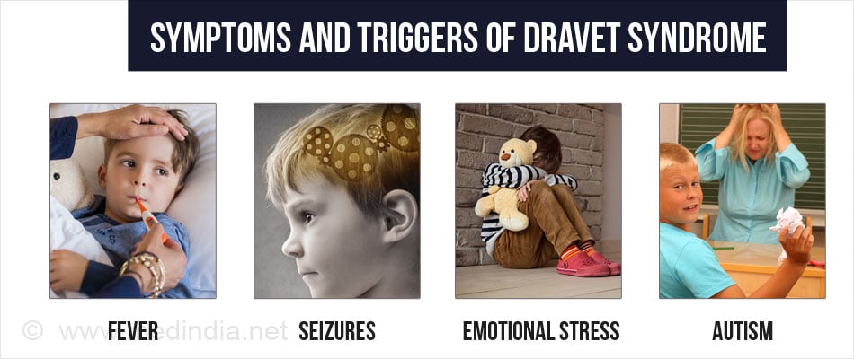 Dravet Syndrome Causes Symptoms Diagnosis Treatment Prevention