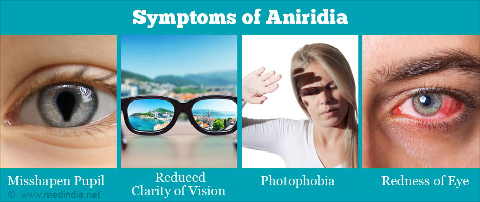 Aniridia - Causes, Symptoms, Diagnosis & Treatment