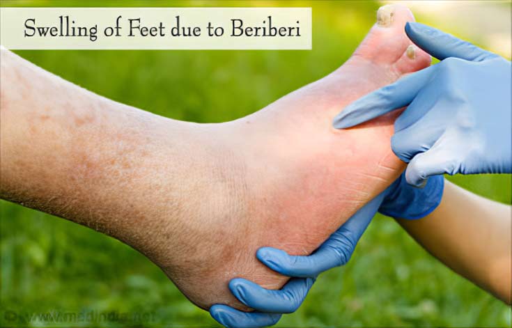 Beriberi Disease - Causes, Risk Factors, Symptoms, Diagnosis, Treatment