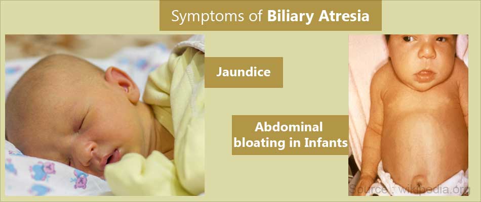 Biliary Atresia - Types, Causes, Symptoms, Diagnosis, Treatment ...
