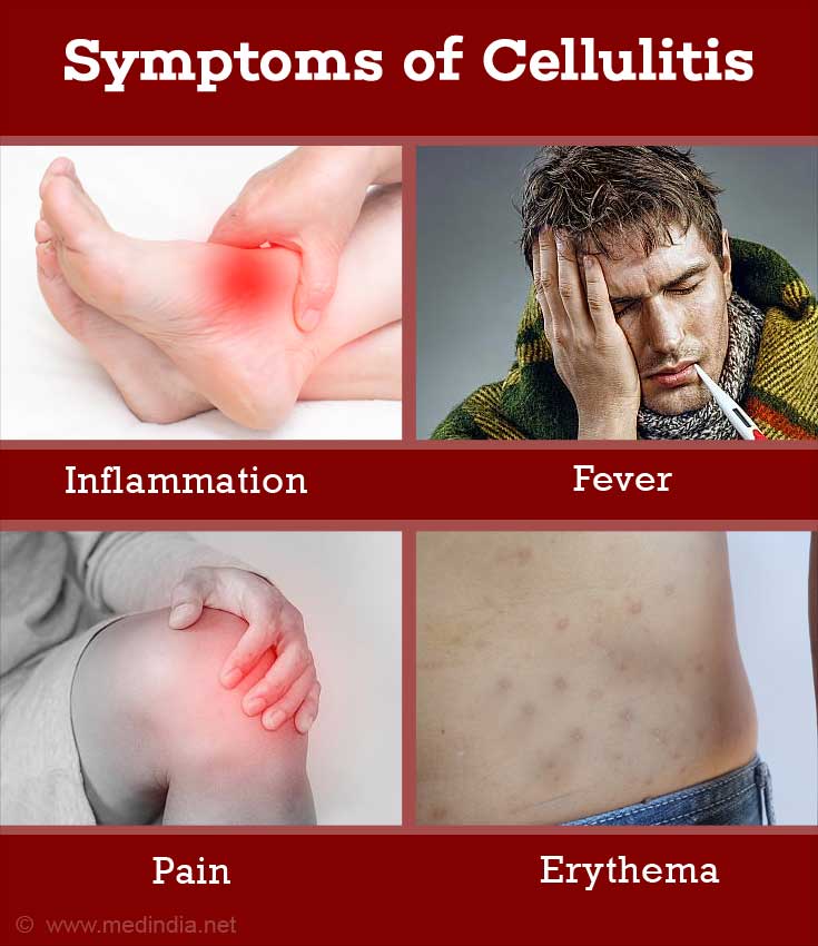symptoms of cellulitis