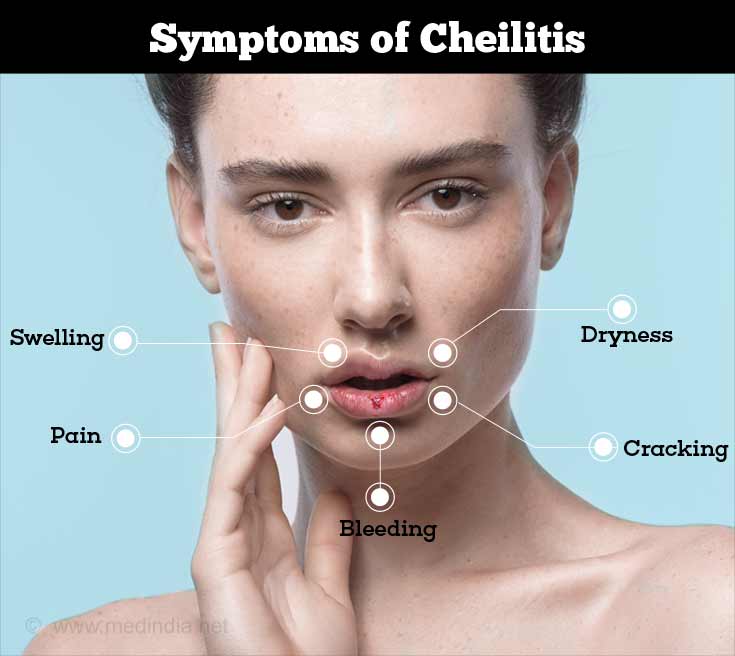 Symptoms of Cheilitis Symptoms of Cheilitis