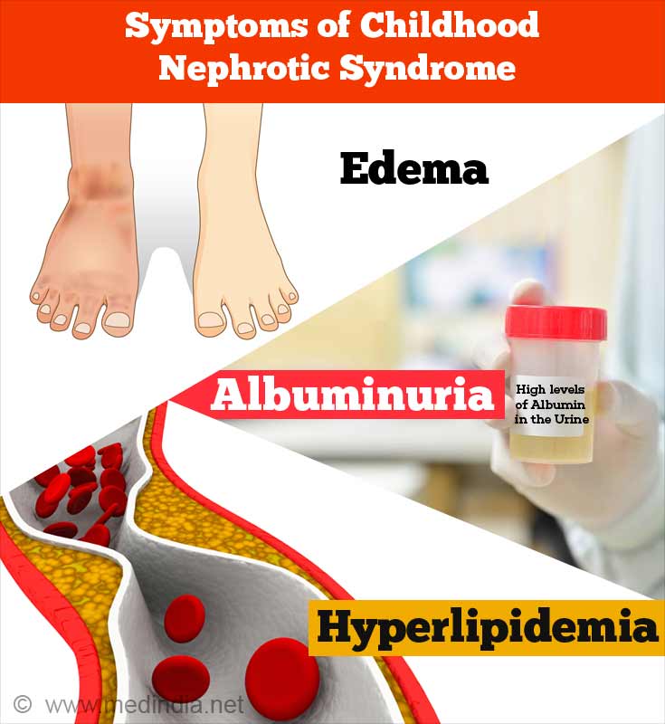 Nephrotic Syndrome Clinical Features
