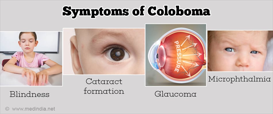 coloboma of the eye