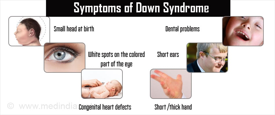 Living with Down Syndrome: Know its symptoms and causes