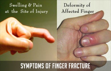 Symptoms of Finger Fracture Symptoms of Finger Fracture