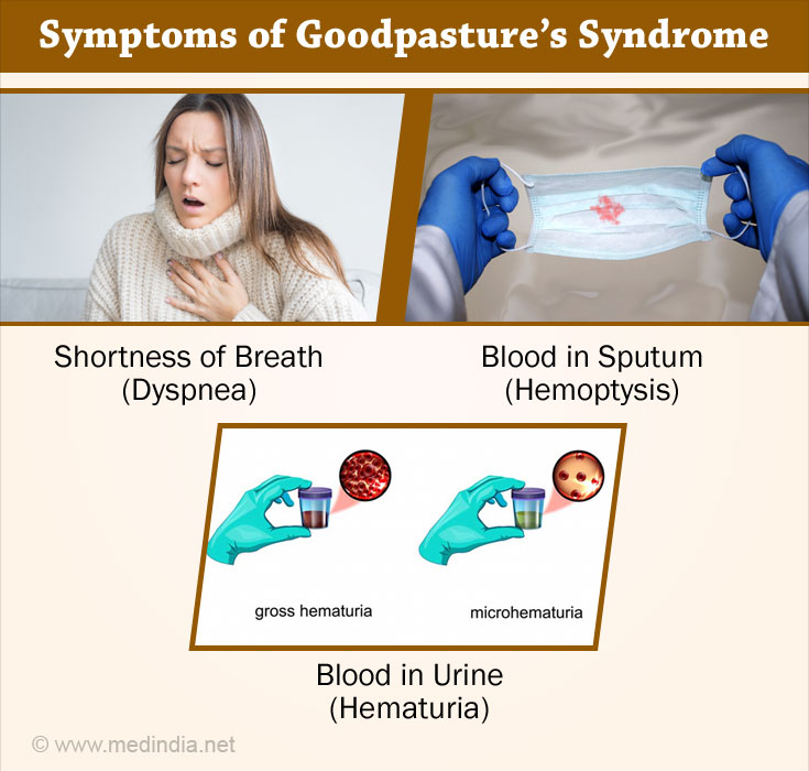 Symptoms of Goodpasture’s Syndrome Symptoms of Goodpasture’s Syndrome