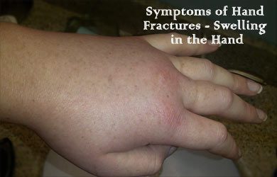 Symptoms of Hand Fractures Symptoms of Hand Fractures