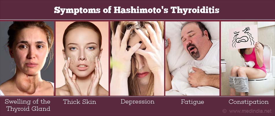 Hashimoto’s Thyroiditis - Risk Factors, Types, Causes, Symptoms ...