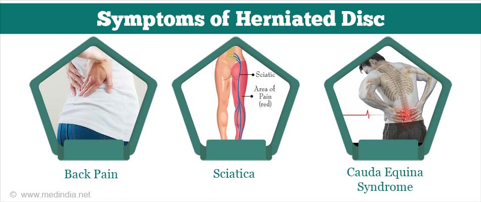 What Is a Herniated Disc? (Signs and Symptoms)