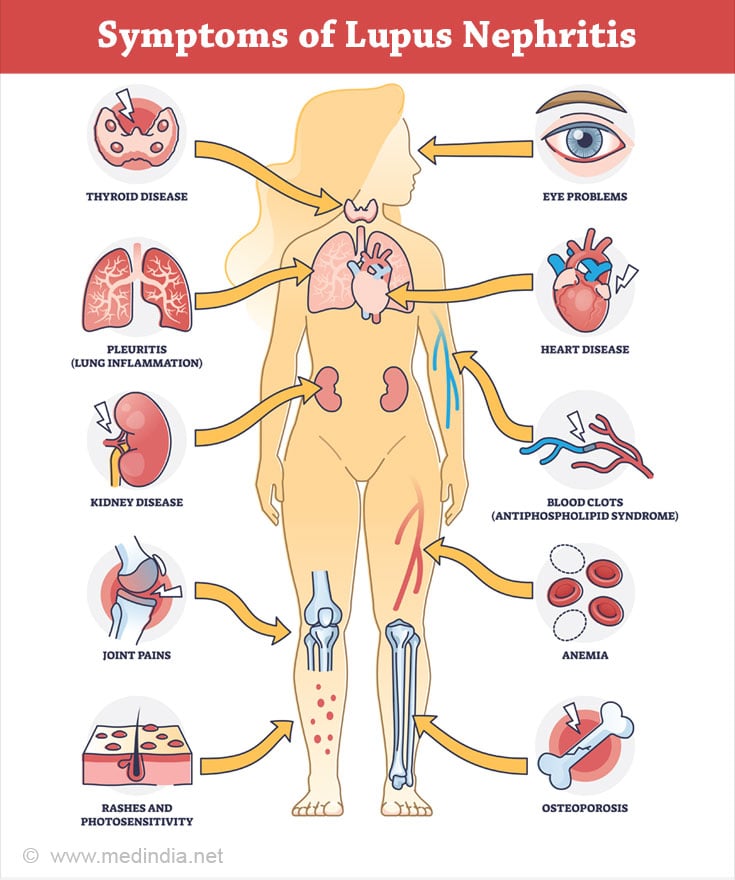 Symptoms of Lupus Nephritis