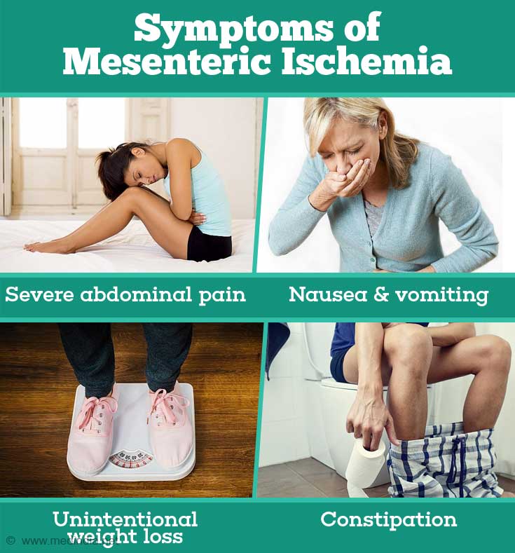 Symptoms of Mesenteric Ischemia Symptoms of Mesenteric Ischemia