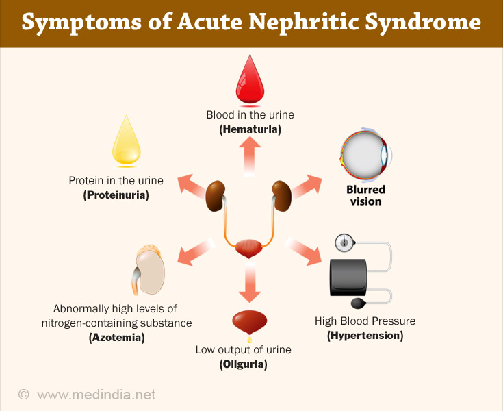 Symptoms of Nephritic Syndrome Symptoms of Nephritic Syndrome