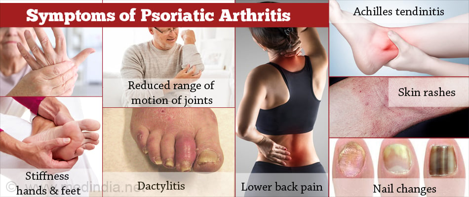 Brote artritis psoriásica