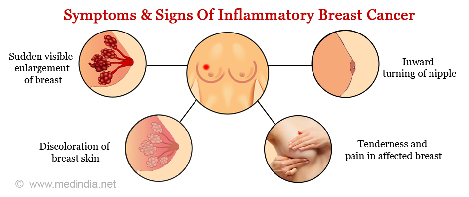 CoppaFeel! on X: Inflammatory breast cancer is a rare type of breast  cancer which may cause the skin on the breast to look red or inflamed. The  symptoms are caused by cancer