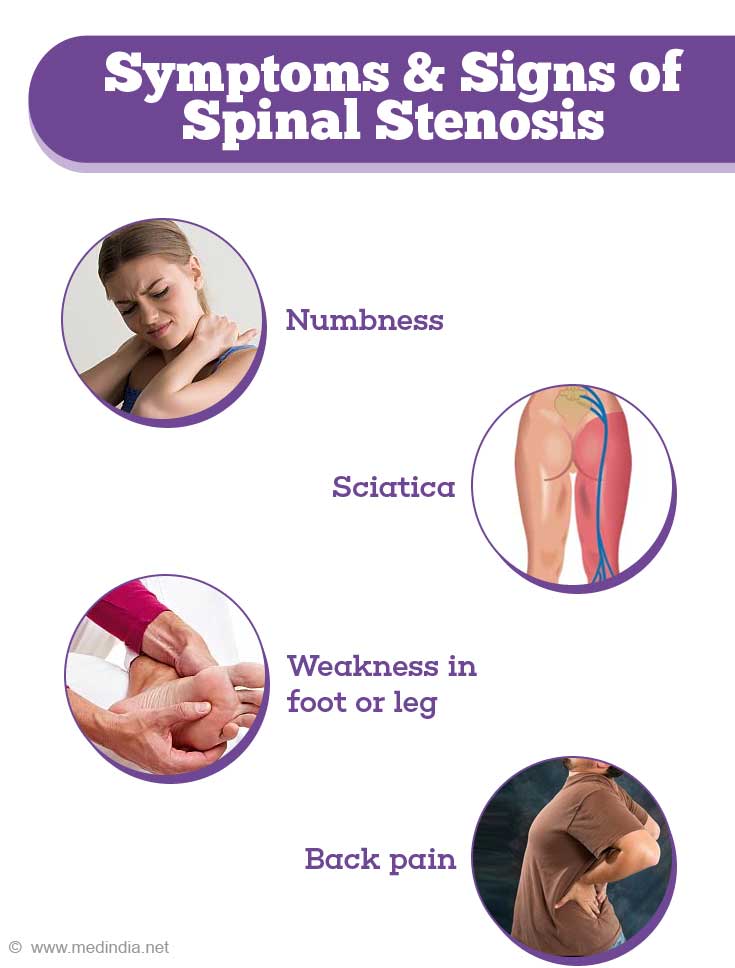 Spinal Stenosis Causes Symptoms Diagnosis And Management 