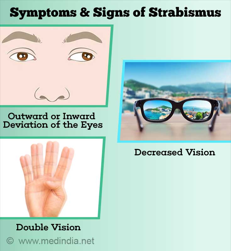 Strabismus Squint Types Causes Symptoms Diagnosis Treatment Prevention