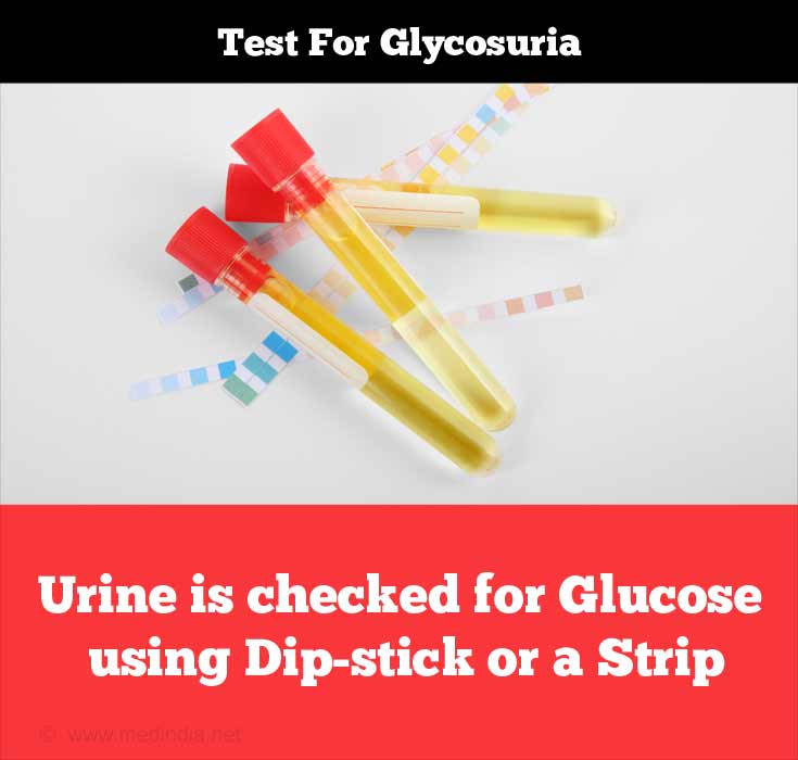 Urine is Checked for Glucose Using Dip-stick or a Strip Urine is Checked for Glucose Using Dip-stick or a Strip