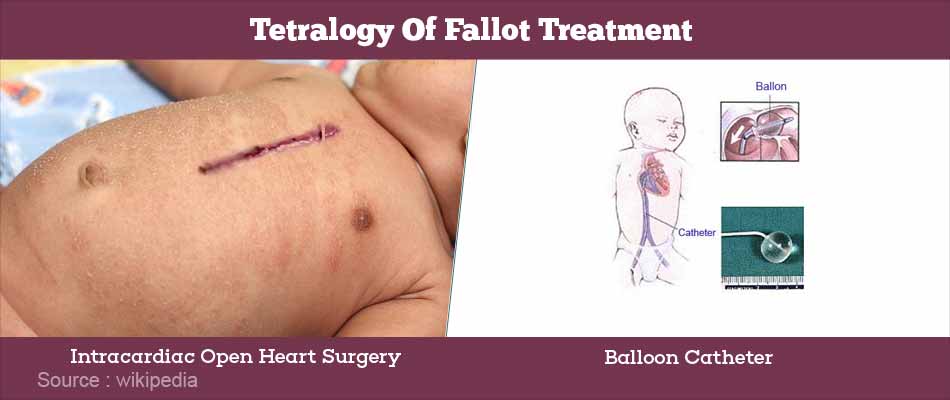 Tetralogy Of Fallot Causes Clinical Features Diagnosis And Treatment