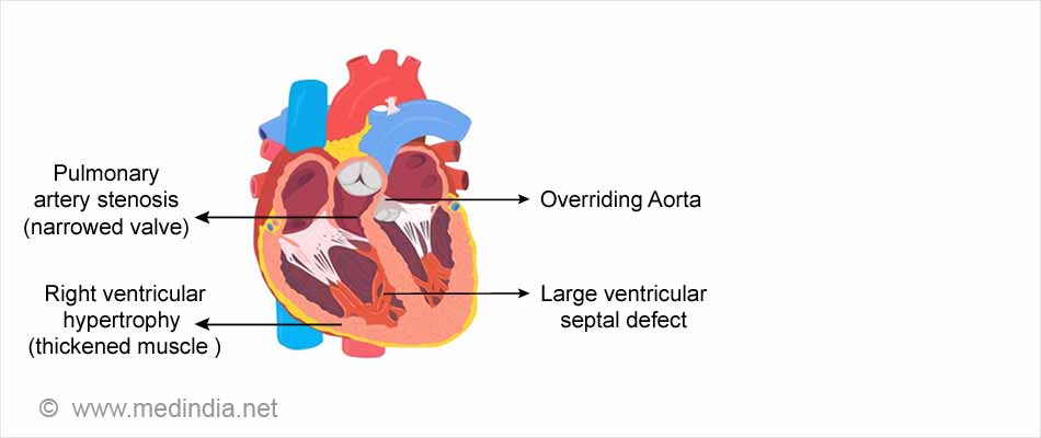 Tetralogy of Fallot: Cyanotic congenital heart defects Tetralogy of Fallot: Cyanotic congenital heart defects