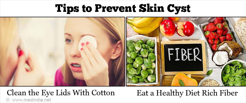 Prevent Skin Cyst