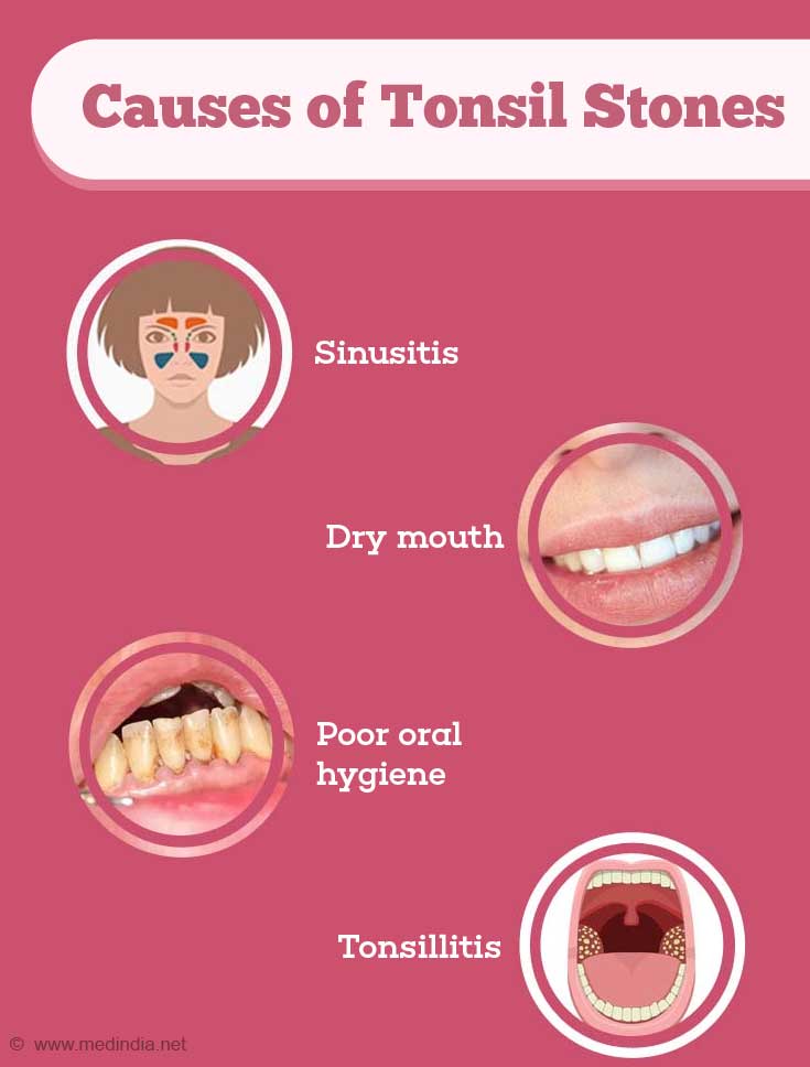 Tonsil Stones Causes Symptoms Diagnosis Treatment And Prevention