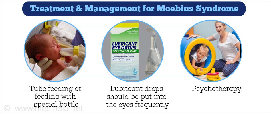 Treatment & Management for Moebius Syndrome Treatment & Management for Moebius Syndrome