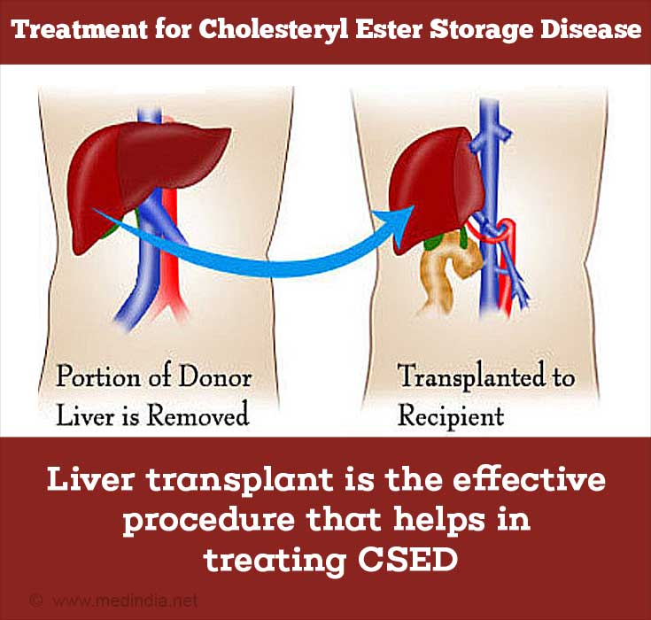 Liver Transplant - Treatment for Cholesteryl Ester Storage Disease Liver Transplant - Treatment for Cholesteryl Ester Storage Disease